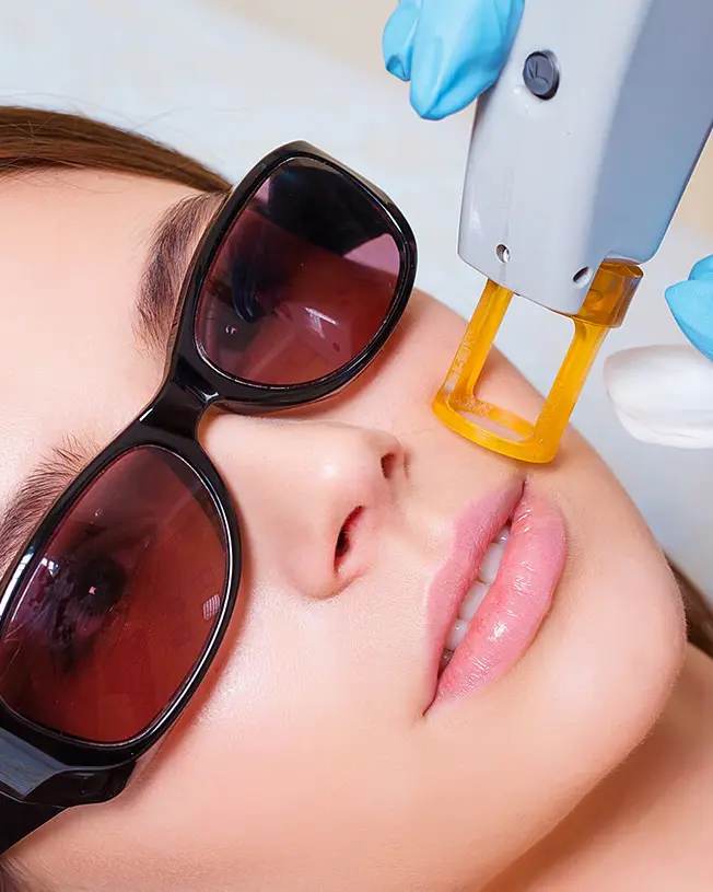 laser removal Calgary