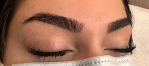 brow correction Calgary