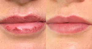 lip blush vs filler Calgary