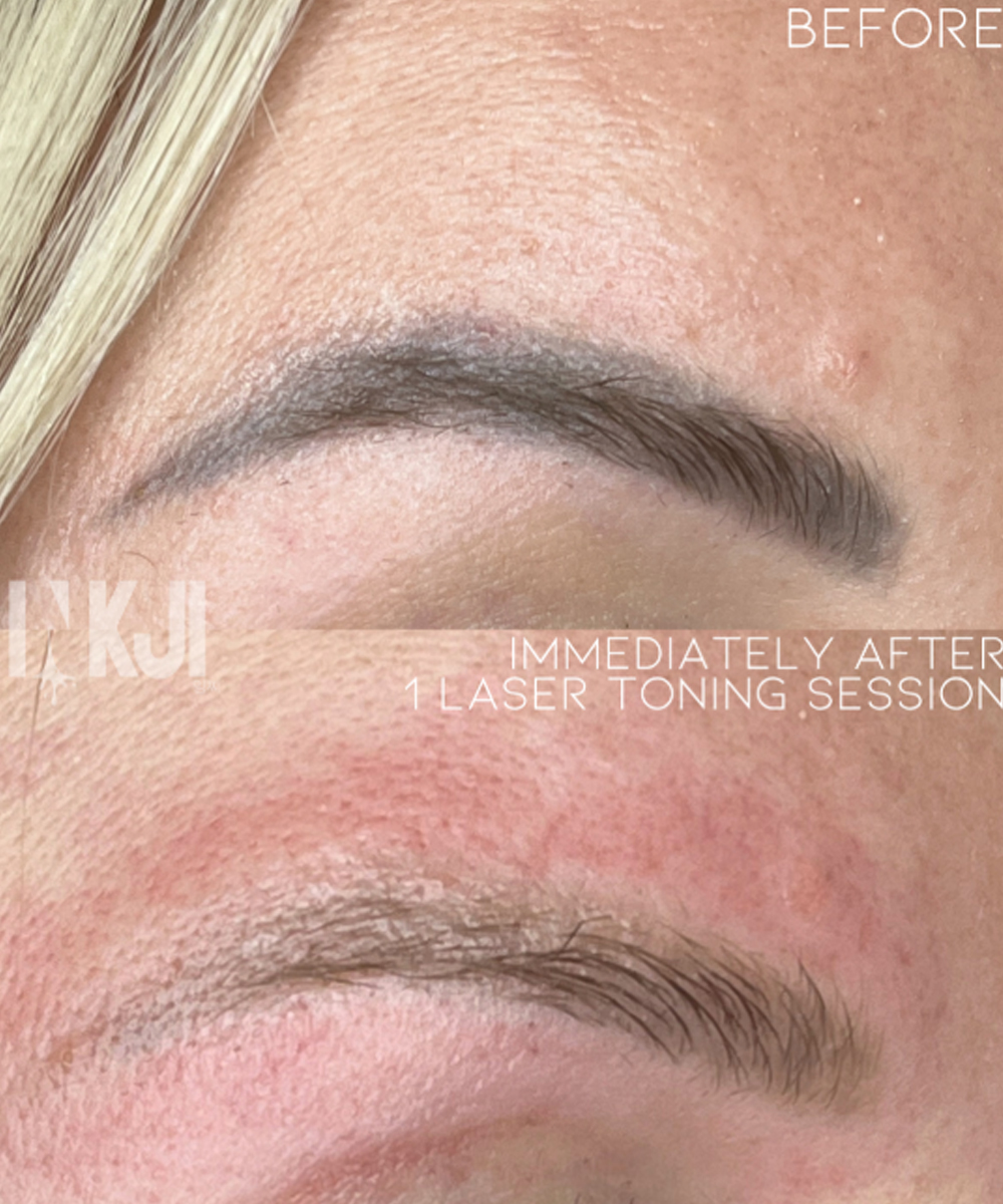 Laser Toning / Removal Latest laser technology to shift current brow colour or to completely remove to start fresh.
